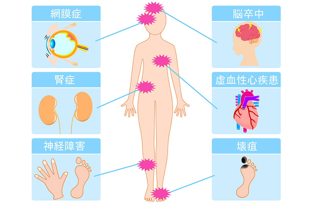 糖尿病と３大合併症