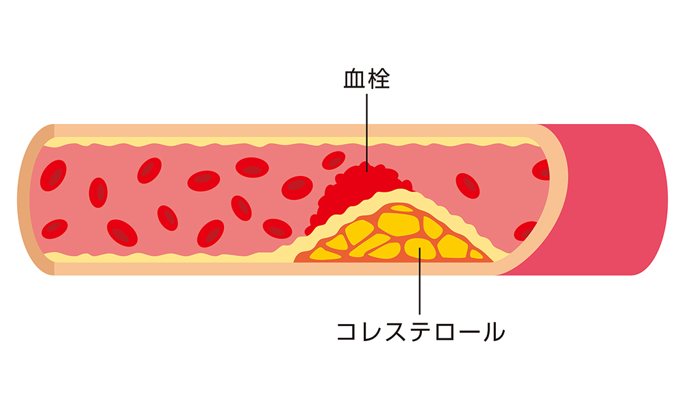 コレステロール値が多いとよくないの？