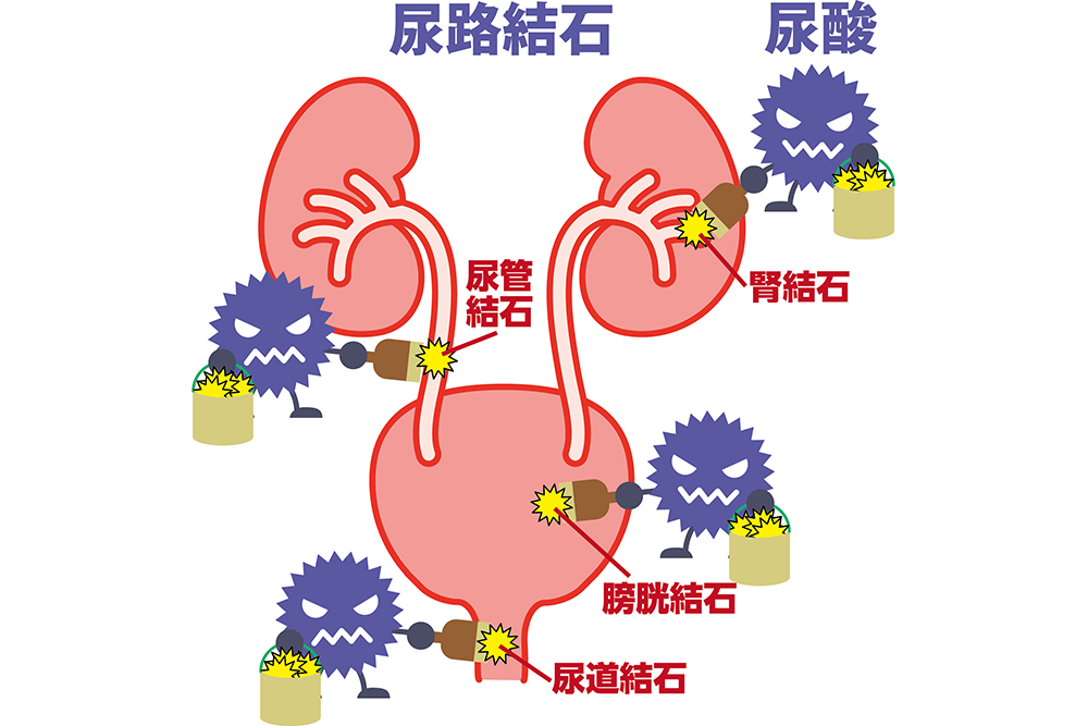 尿路結石