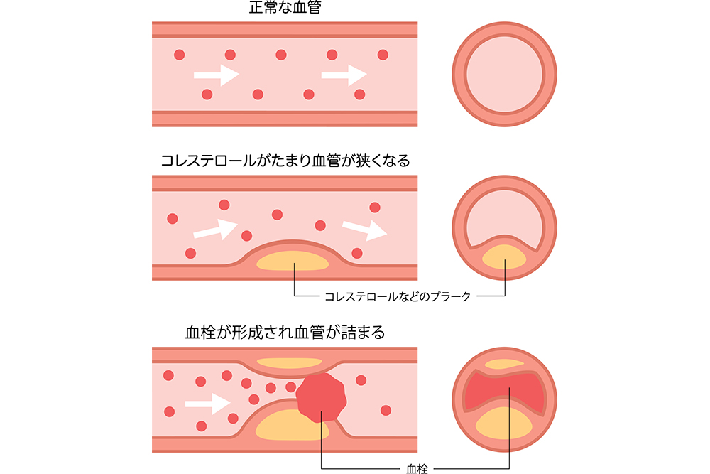 チーズとコレステロール