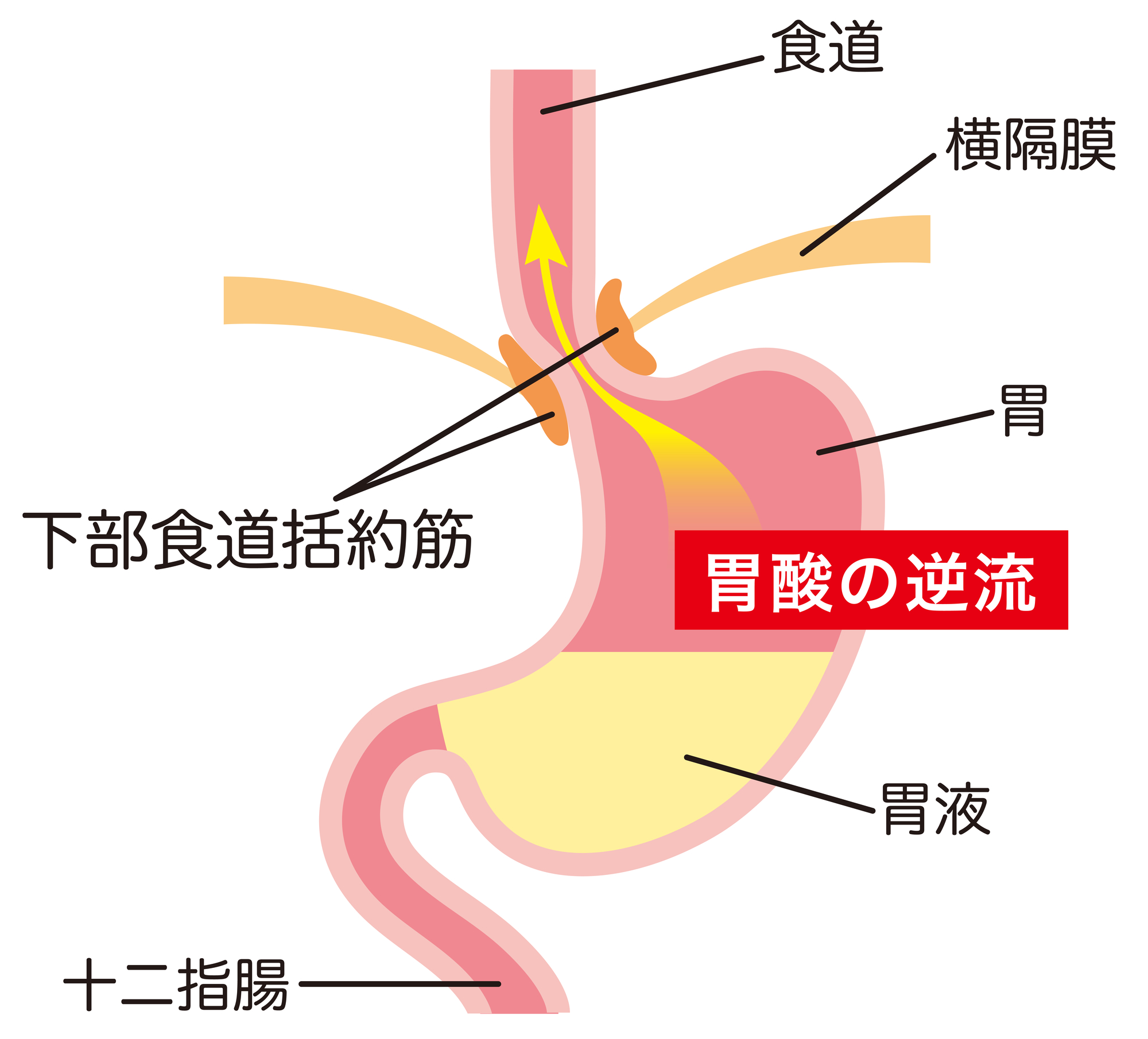 逆流性食道炎とは