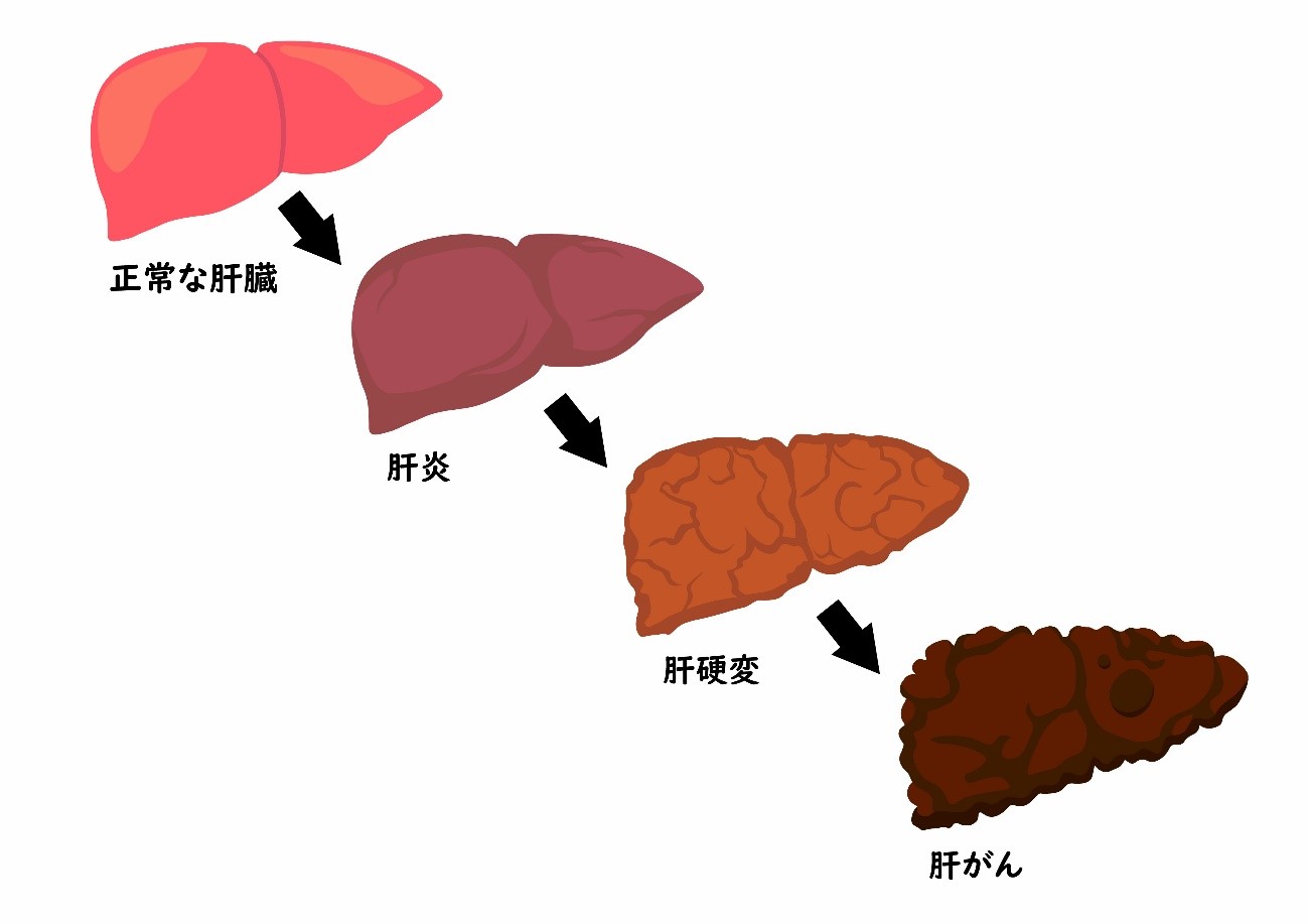 脂肪肝を放っておいたらどうなる？